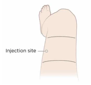 Thigh injection site.png